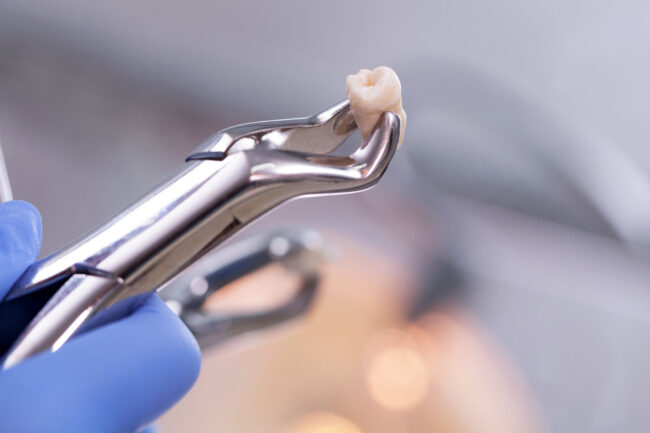 dental extraction Extracted Tooth