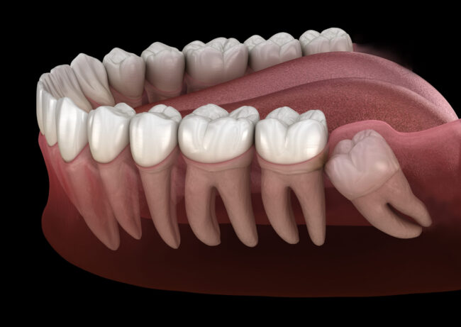 oral and maxillofacial impacted wisdom tooth
