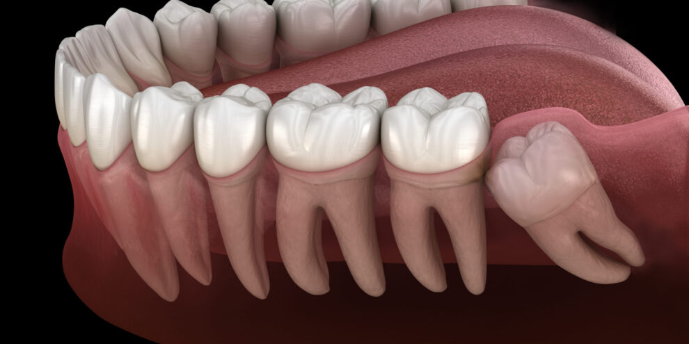 oral and maxillofacial impacted wisdom tooth